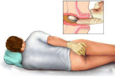 Điều trị bệnh trĩ tại nhà