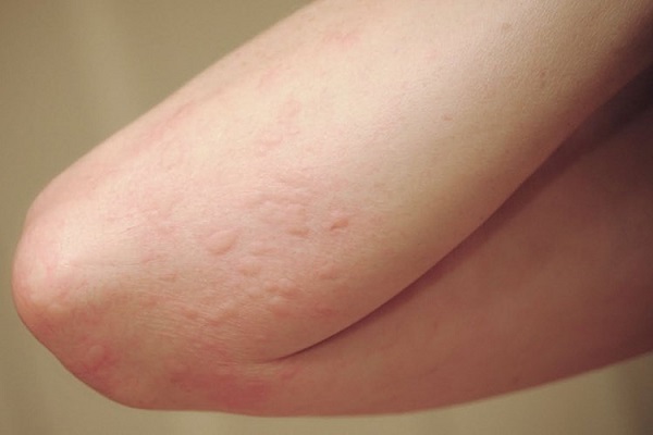 Dấu hiệu viêm da dị ứng