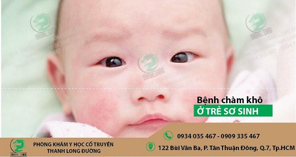 Trị bệnh chàm trẻ em