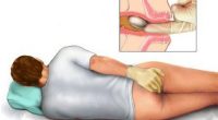 Điều trị bệnh trĩ tại nhà